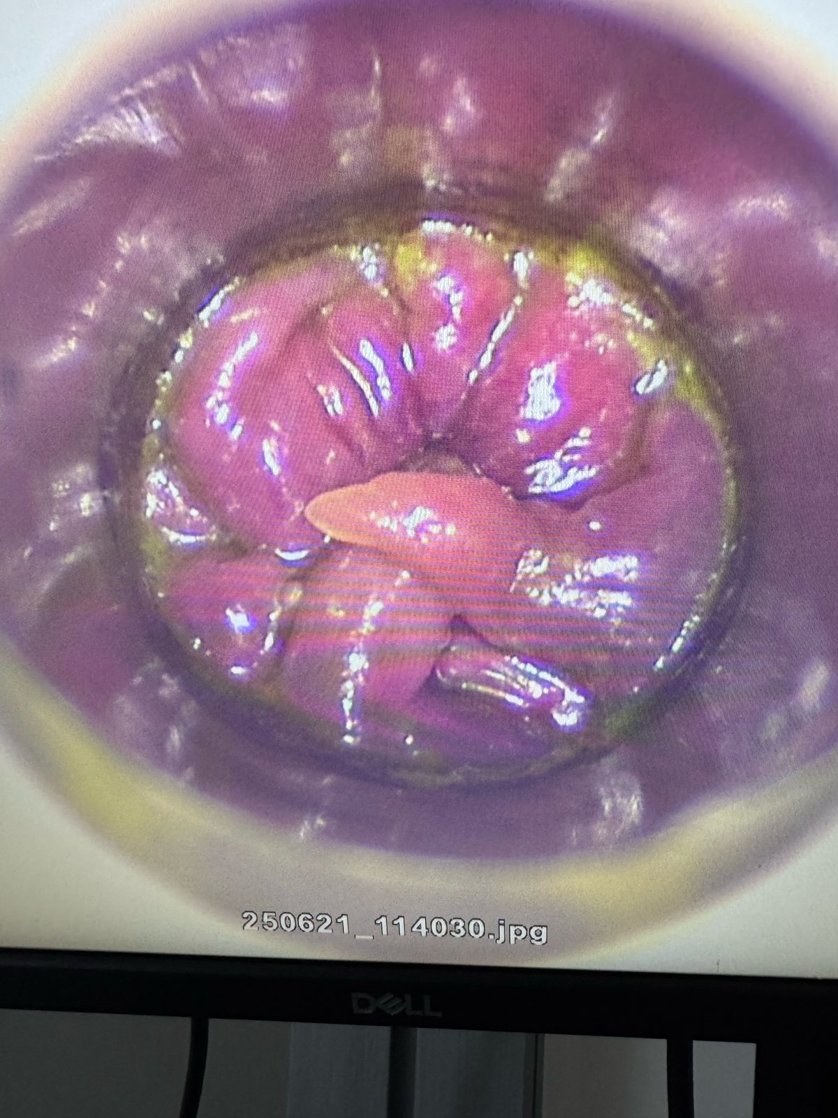 Video anoscopy view of internal hemorrhoids — graphic medical imagery