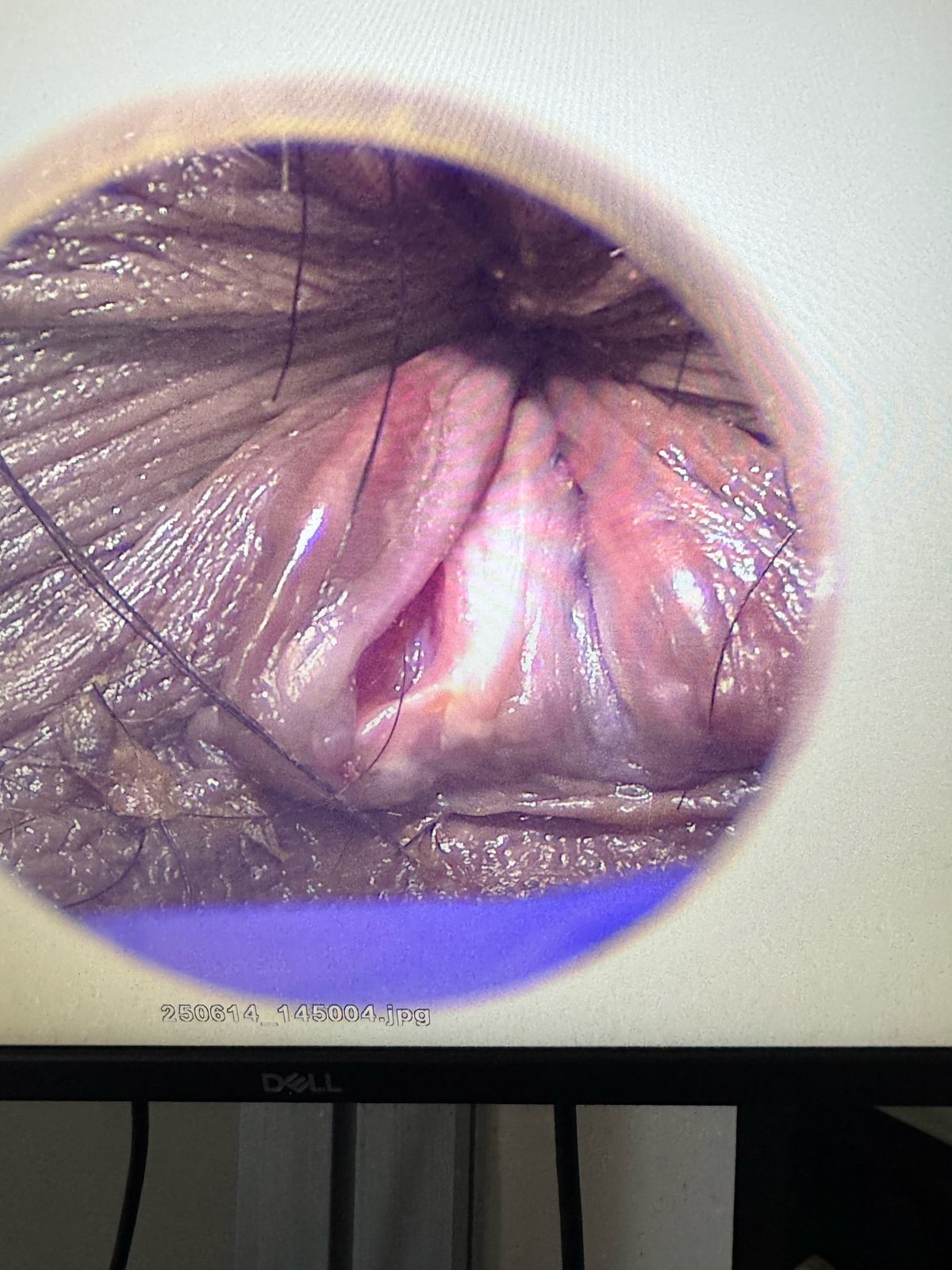 Video anoscopy view of internal hemorrhoids — graphic medical imagery