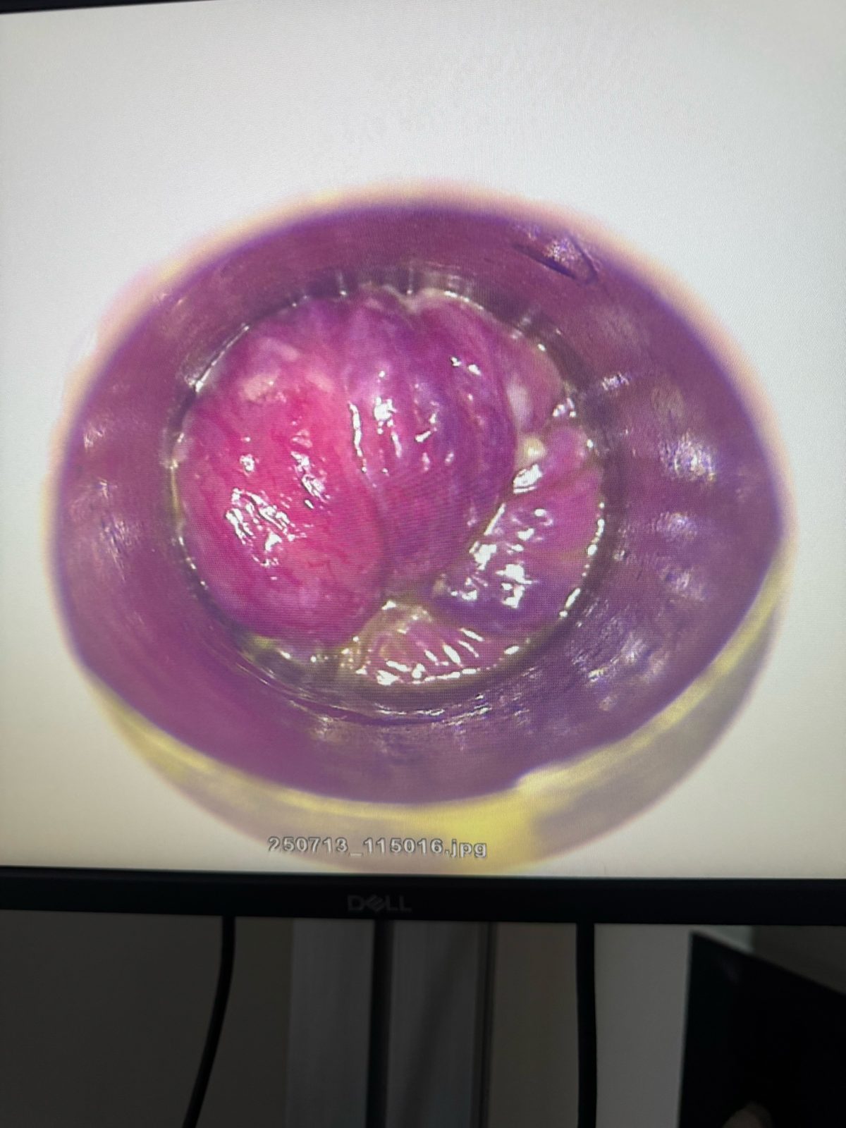 Video anoscopy view of internal hemorrhoids — graphic medical imagery