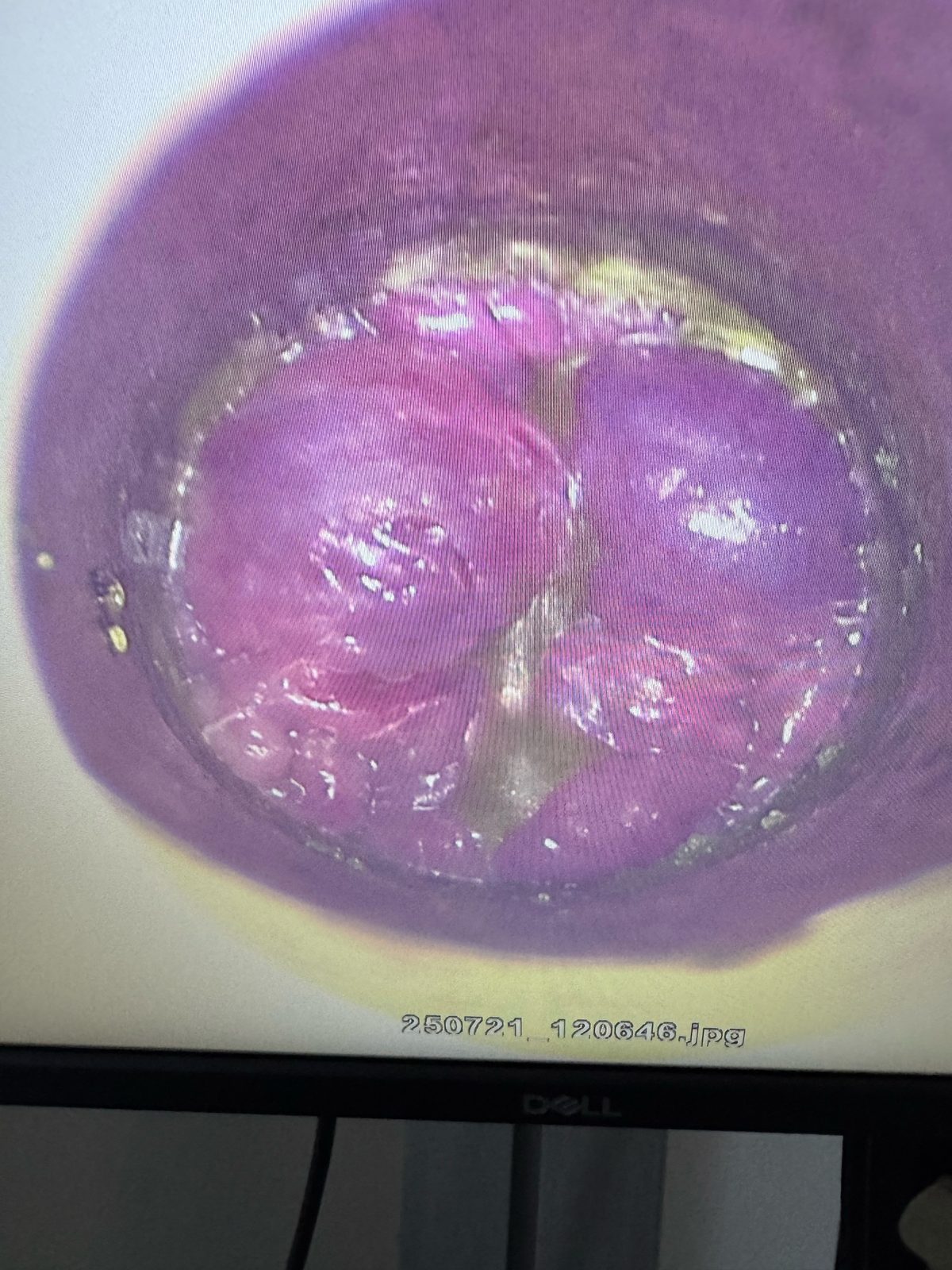 Video anoscopy view of internal hemorrhoids — graphic medical imagery
